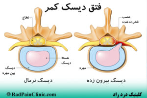 تزریق دیسکوژل کمر و گردن برای درمان فتق دیسک در کلینیک درد ارد
