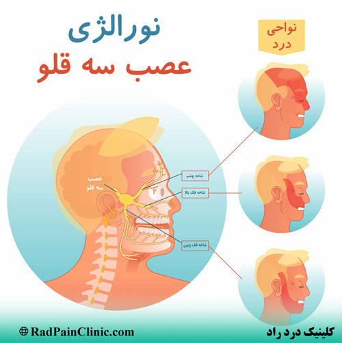 نواحی درد عصب سه قلو کلینیک درد راد