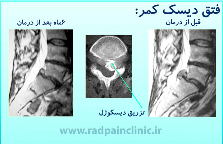 تزریق دیسکوژل گردن و کمر در کلینیک درد راد