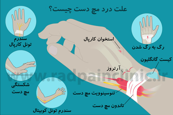 علت درد مچ دست