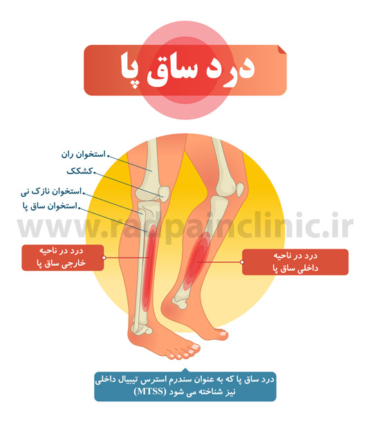آناتومی استخوان ساق پا و علت درد ساق پا