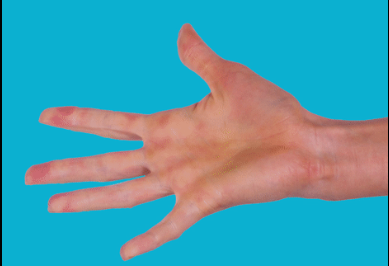 درمان انگشت ماشه ای در کلینیک درد راد