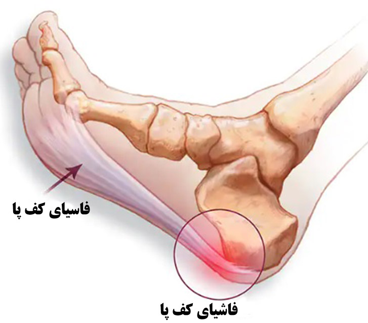درمان درد پاشنه پا در کلینیک درد راد