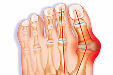 درمان انحراف شست پا در کلینیک درد راد